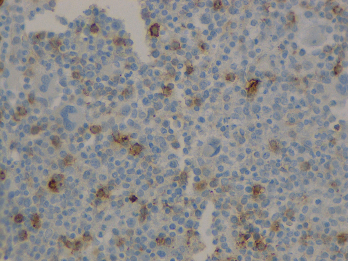 Bone marrow biopsy: CD34